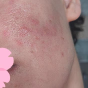 Ürün Nedeniyle Cilt Sorunları Ve Psikolojik Etkiler: Acil Çözüm Talebi