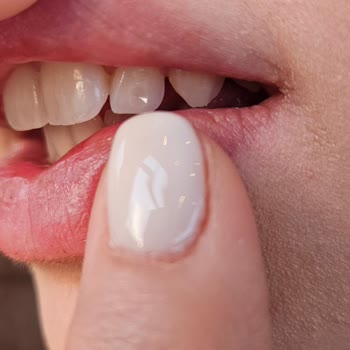 Diş Piercingi Sonrası Taşın Düşmesi Ve İlgisiz Doktor Deneyimi