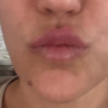 Maya Estetik Beklentilerimi Karşılamayan Estetik İşlemler ve Yetersiz Müşteri İletişimi