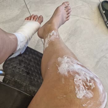 Stanley Termosun Kapağı Patladı, Ayağım Yandı: Acil Dönüş Bekliyorum