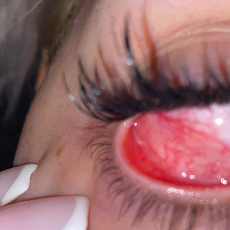 Güzellik İşlemi Sonrası Yaşanan Göz Sağlığı Problemi