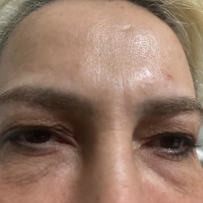 Alanya Lazergöz Tıp Merkezi'nde Botoks Mağduriyeti