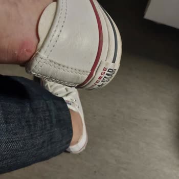 Converse Ayakkabı Yara Yaptı, Çözüm Sunulmadı