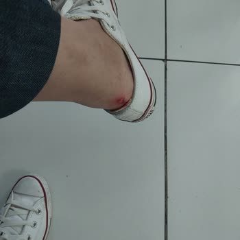 Converse Ayakkabı Yara Yaptı, Çözüm Sunulmadı