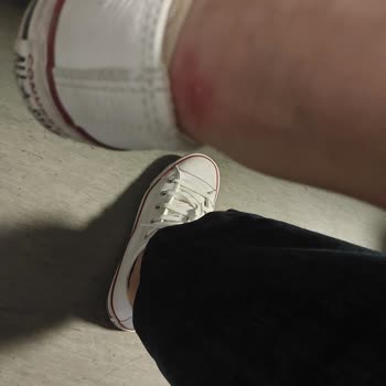 Converse Ayakkabı Yara Yaptı, Çözüm Sunulmadı