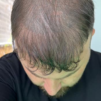 Saç Simülasyonu Sonrası Kalıcı Renk Değişimi Mağduriyeti