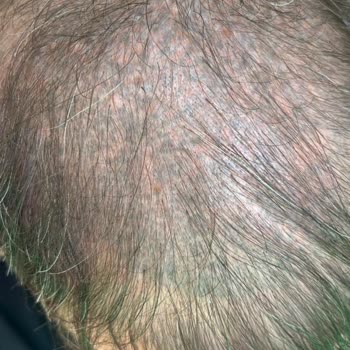 Saç Simülasyonu Sonrası Kalıcı Renk Değişimi Mağduriyeti