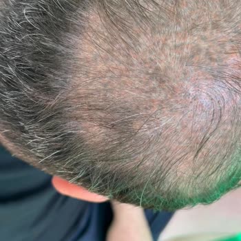 Saç Simülasyonu Sonrası Kalıcı Renk Değişimi Mağduriyeti