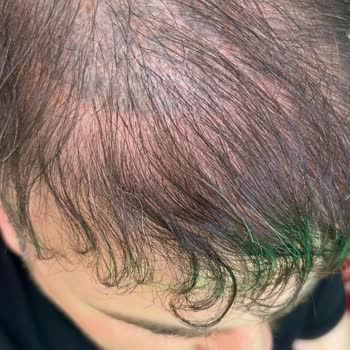 Saç Simülasyonu Sonrası Kalıcı Renk Değişimi Mağduriyeti