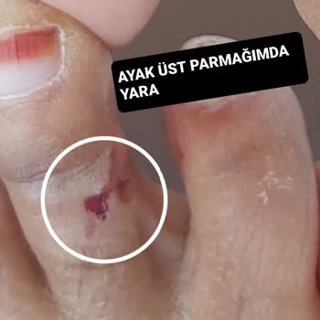 Plastik Terlik Kullanımı Sonrası Sağlık Sorunları Ve Para İadesi Talebi