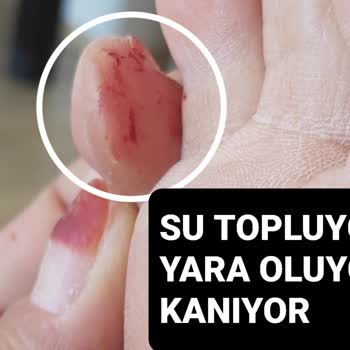 Plastik Terlik Kullanımı Sonrası Sağlık Sorunları Ve Para İadesi Talebi