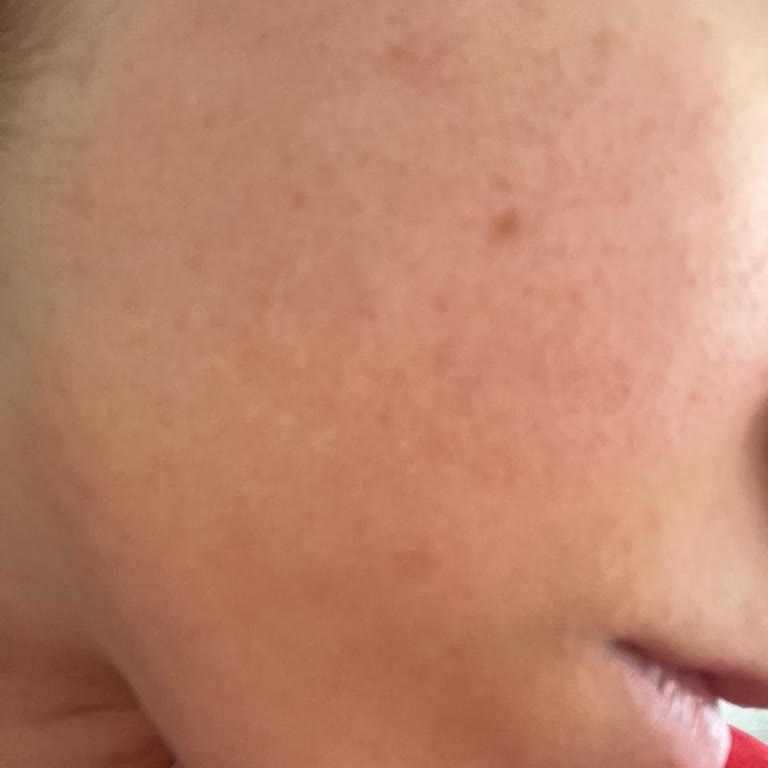 Arbutin Serum Cildimi Tahriş Etti, Para İadesi İstiyorum