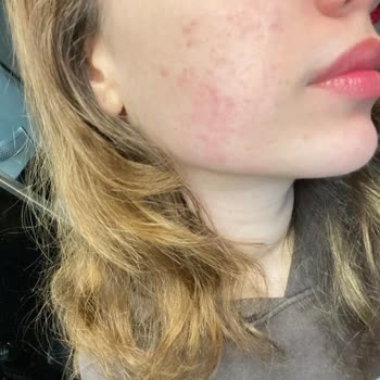 Bioderma Sebium Jel Yüzümde Kabarcık Ve Kızarıklık Yaptı, Hayal Kırıklığı Yaşadım