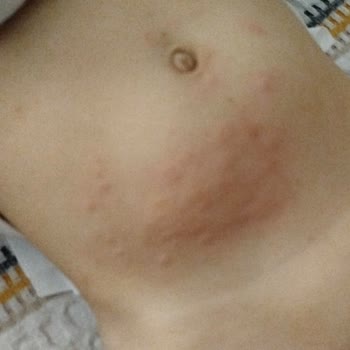 Jenny & Willy Bebek Bezinde Ciddi Alerji Ve Kaşıntı Sorunu Yaşadık!