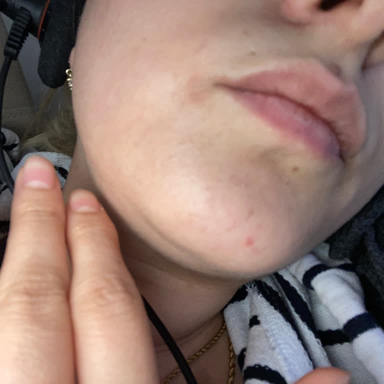 I Developed Severe Dryness and Dark Patches After Using La Roche-Posay Products