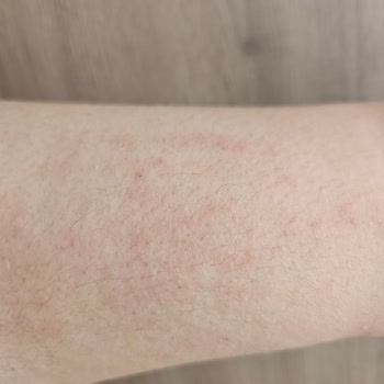 I Experienced Allergy and No Sun Protection with La Roche-Posay Anthelios UVMune 400