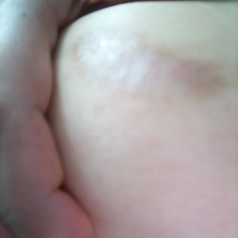 Ameliyat Sonrası Yetersiz Bilgilendirme Ve Kalıcı İz Sorunu Yaşadım