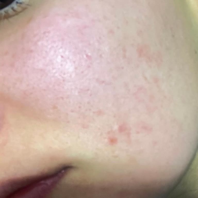 Раздражение кожи после использования геля для умывания Nivea Care