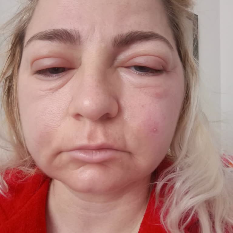 Аллергия на крем для рук Nivea, купленного