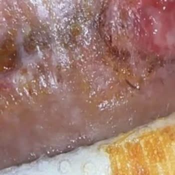 Ameliyat Sonrası Ciddi Yanık Ve Nekrozla Hayatım Karardı