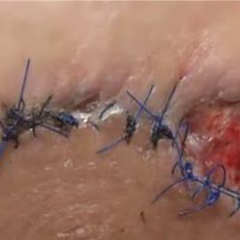 Ameliyat Sonrası Ciddi Yanık Ve Nekrozla Hayatım Karardı