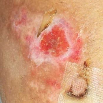 Ameliyat Sonrası Ciddi Yanık Ve Nekrozla Hayatım Karardı