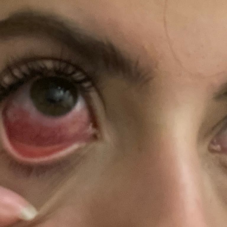 Aymira Koçaklı Yaşam Merkezi İpek Kirpik Uygulaması Sonrası Gözümde Enfeksiyon Ve Memnuniyetsizlik