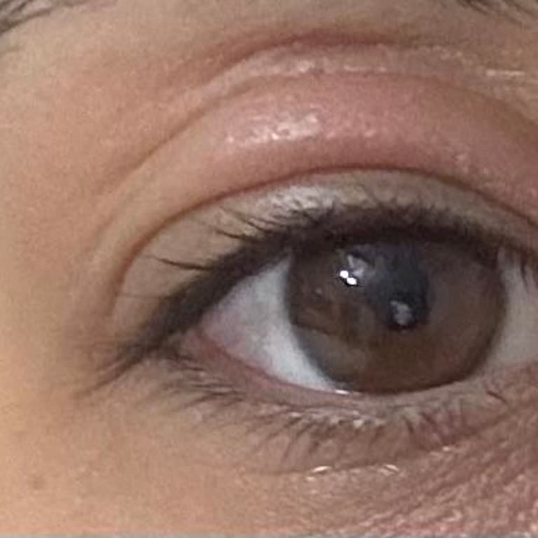 The Purest Solutions Göz Altı Serumu Sonrası Beklenmedik Cilt Reaksiyonu Yaşadım