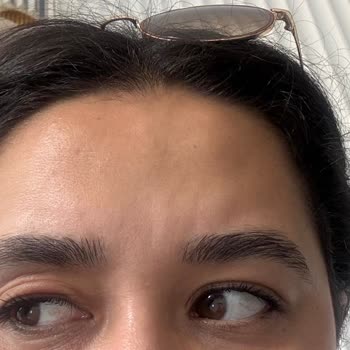 The Purest Solutions Göz Altı Serumu Sonrası Beklenmedik Cilt Reaksiyonu Yaşadım