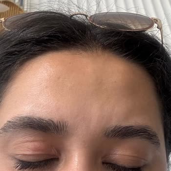 The Purest Solutions Göz Altı Serumu Sonrası Beklenmedik Cilt Reaksiyonu Yaşadım