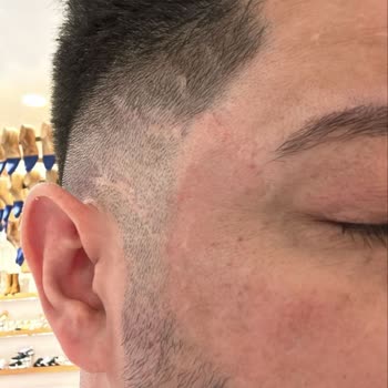 Enza Güzellik Merkezleri Cilt Lekeleri İçin Alınan Hizmetten Memnuniyetsizlik Ve Maddi Zarar