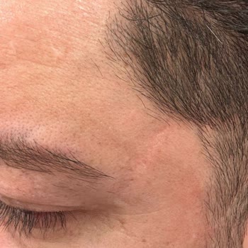 Enza Güzellik Merkezleri Cilt Lekeleri İçin Alınan Hizmetten Memnuniyetsizlik Ve Maddi Zarar