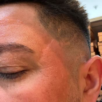 Enza Güzellik Merkezleri Cilt Lekeleri İçin Alınan Hizmetten Memnuniyetsizlik Ve Maddi Zarar