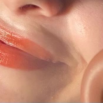 Dudak Dolgusu Sonrası Şişlik Ve Eksik Ücret İadesi Sorunu