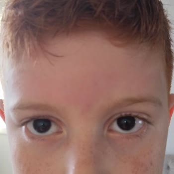 Johnson Baby Şampuanın Alerjik Etki Göstermesi