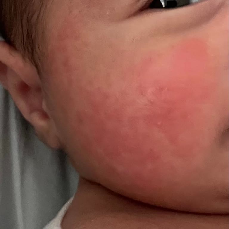 Aldığım Mama Bebeğimde Alerji Ve Gaz Yaptı, İade Talep Ediyorum