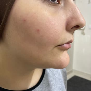 Pure Beauty Ürünleri Cildimde Sivilceye Sebep Oldu, Hayal Kırıklığı Yaşadım