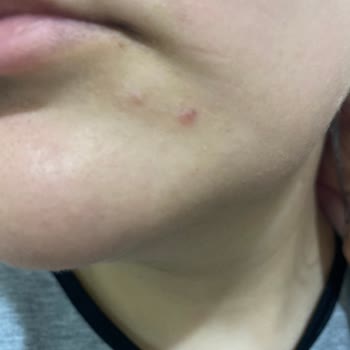 Pure Beauty Ürünleri Cildimde Sivilceye Sebep Oldu, Hayal Kırıklığı Yaşadım