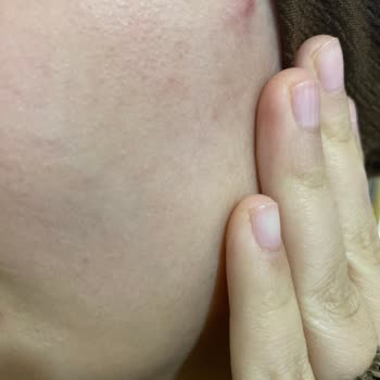 Pure Beauty Ürünleri Cildimde Sivilceye Sebep Oldu, Hayal Kırıklığı Yaşadım