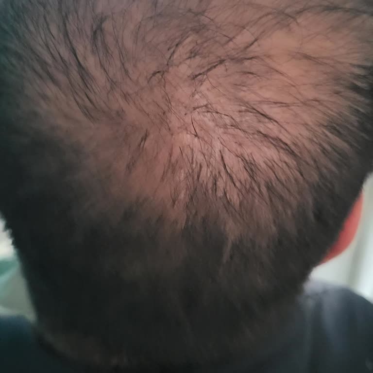 Saç Ekimi Sonrası Beklenen Sonuç Alınmadı PRP Seansları Da Fayda Etmedi