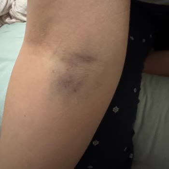 Damar Uyarıma Rağmen Yanlış Uygulama Sonucu Ağrılı Ve Morarmış Kol