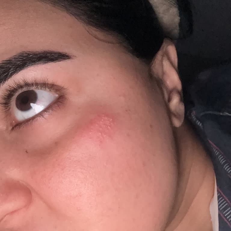 Üzüm İksiri Ürünü Cildimde Alerji Ve Kabarcık Yaptı, Çözüm Bekliyorum