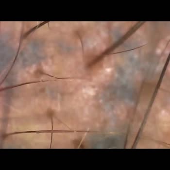 Celal Akfil Saç Gölgelendirme Yanıltıcı Bilgi Ve Kalıcı Mavi Lekelerle Saç Simülasyonu Mağduriyeti