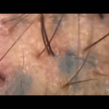 Celal Akfil Saç Gölgelendirme Yanıltıcı Bilgi Ve Kalıcı Mavi Lekelerle Saç Simülasyonu Mağduriyeti