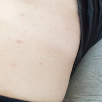 Bioblas Şampuan Kullanımı Sonrası Alerjik Reaksiyon Ve Kaşıntı