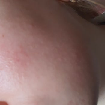 Arko Avokado Yağı Kremi Cildimde Tahriş Ve Kızarıklık Yaptı