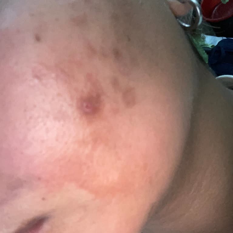 Krem Yüzümde Yanık Ve Lekelere Sebep Oldu