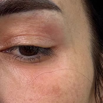 Hediye Göz Kremi Cildimde Yanma Ve Kaşıntıya Sebep Oldu