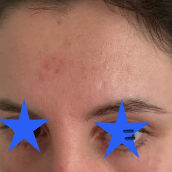 Kullandığım Krem Cildimi Mahvetti Ve Sivilcelerim Arttı