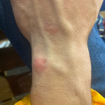 Saat Kordonunun Bilekte Yara Yapması Ve Garanti Servisinin Sorunu Çözmemesi